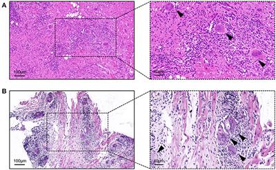 Clinical Identification and Characteristic Analysis of Giant Cell Myocarditis in 12 Cases